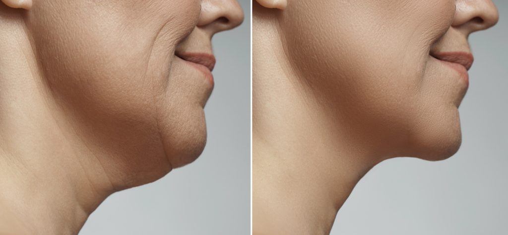 Difference after neck liposuction.
