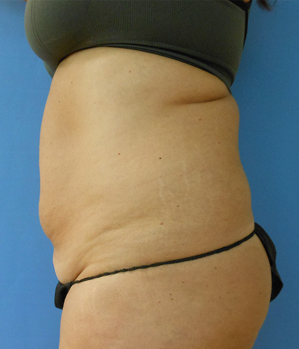 Side view of a torso with visible skin texture and a dark waistband. Background is blue