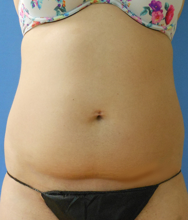 A front view of a torso wearing a floral bikini top and black bikini bottom