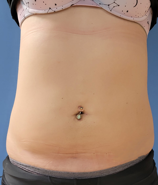 Close-up of a bare abdomen with a belly button piercing and faint stretch marks