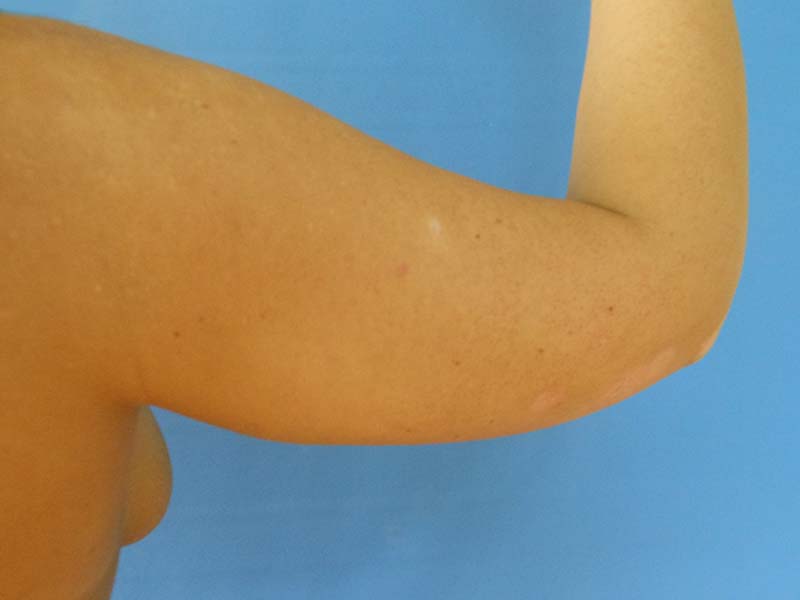 A close-up of a bare arm, showing skin tone and a small scar, against a blue background
