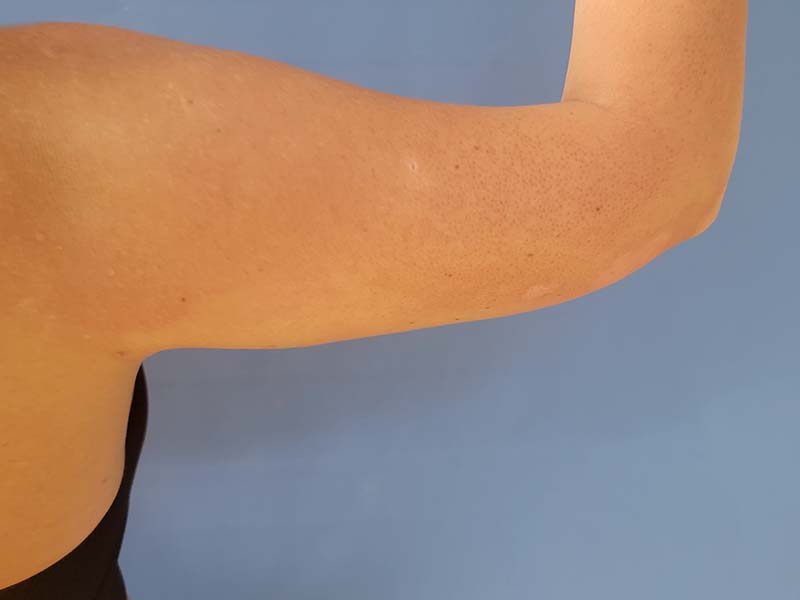 A close-up of a person's upper arm against a blue background