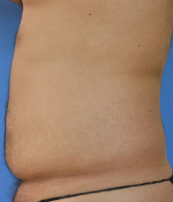 Side view of a torso showing skin with stretch marks and a slight bulge