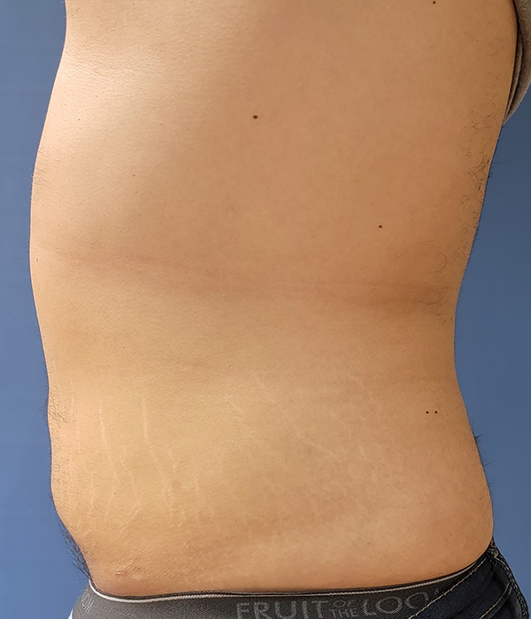 Side view of a torso with visible skin texture and faint stretch marks