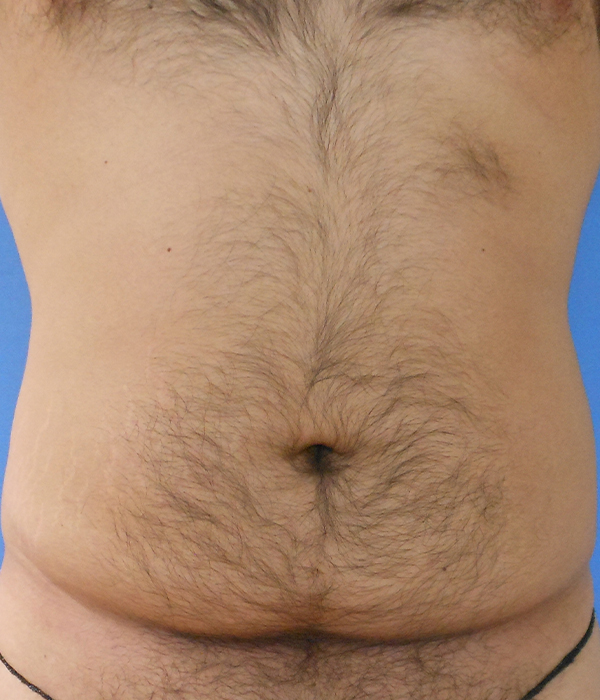Bare torso with visible hair and abdominal area against a blue background