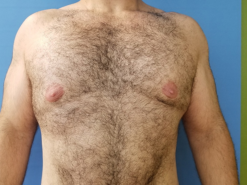 A man's bare, hairy chest with visible nipples, against a blue background
