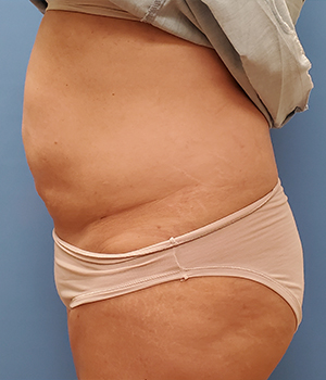 Side view of a person wearing beige underwear, showing stomach and skin texture