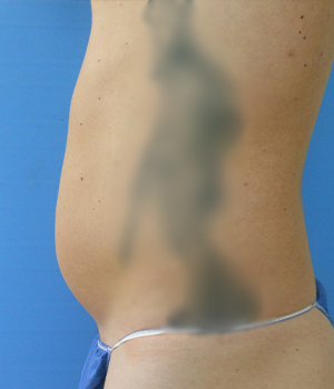 Side view of a torso with a slight bulge, blurred background
