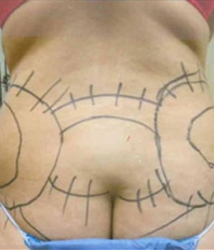 Back view of a person's lower back with markings and lines drawn in a symmetrical pattern