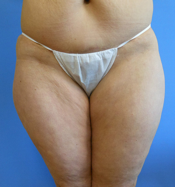 Close-up of thighs and abdomen, wearing light-colored underwear against a blue background