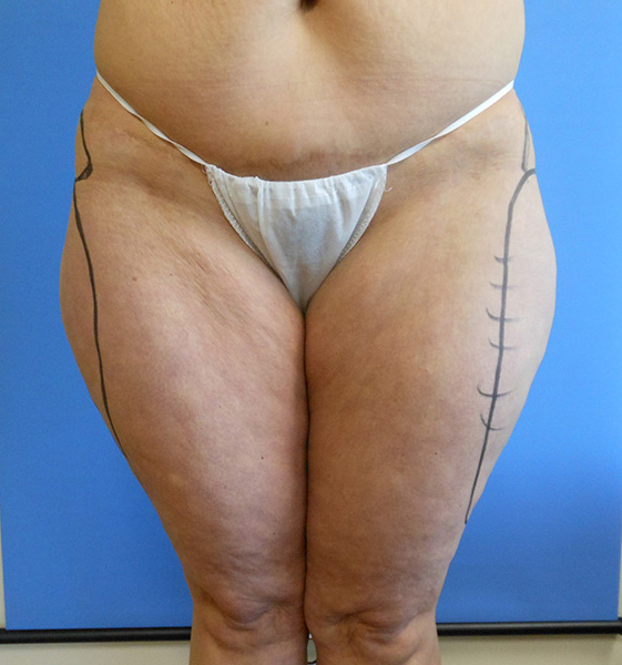 Close-up view of thighs, wearing a thong, with markings on skin