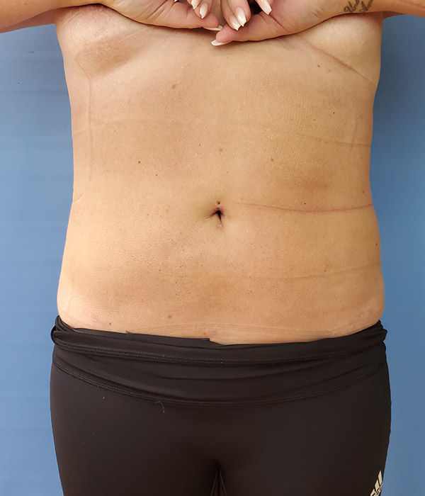 A human torso shown from the front, wearing black shorts, against a blue background