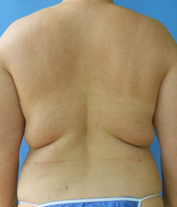 Person's bare back, showing skin tone and shoulder contours, against a blue background