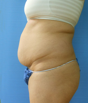 Side view of a person's torso with a visible belly and wearing a striped top and underwear