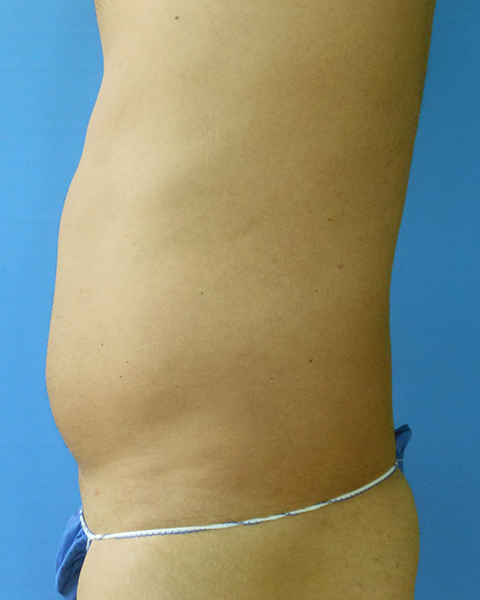 Side view of a torso with a visible abdomen. Background is a solid blue color