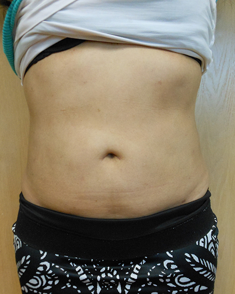 A bare midsection showing skin tones and slight stretch marks. Upper shirt raised
