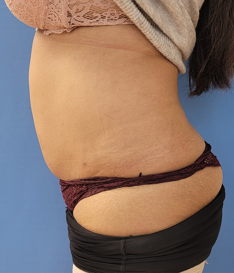 Side view of a person wearing underwear, showing a bare abdomen and skin texture