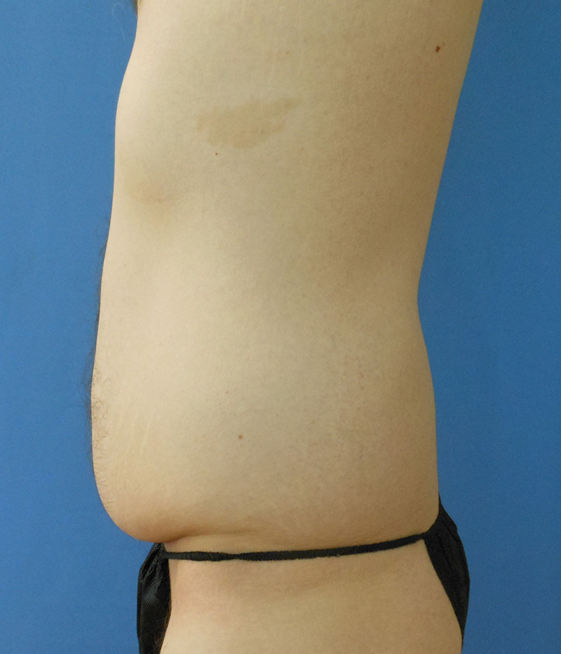 Side view of a person's torso against a blue background, showing a slightly protruding abdomen