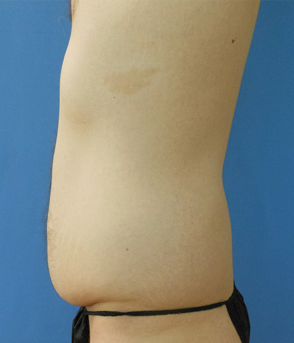 Side view of a bare torso with a slight protrusion of the abdomen against a blue background