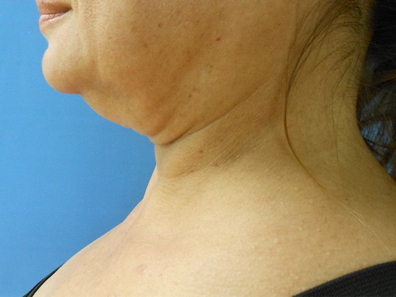 Profile view of a woman with visible chin and neck features against a blue background