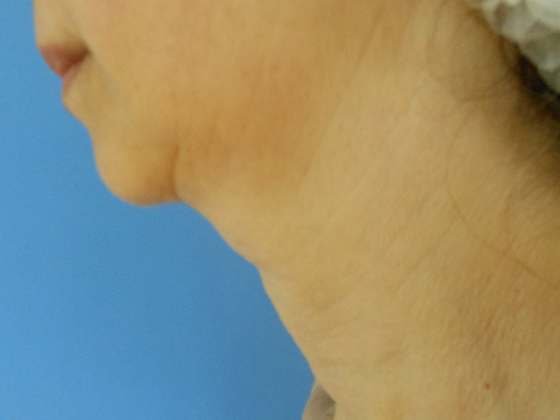 Side view of a person's neck and chin against a blue background
