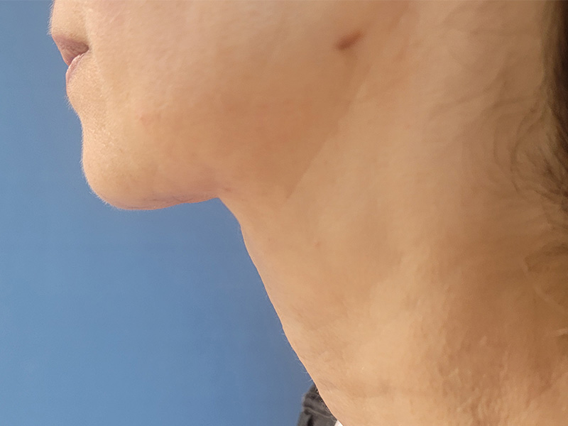 Side profile of a person’s neck and jawline against a blue background