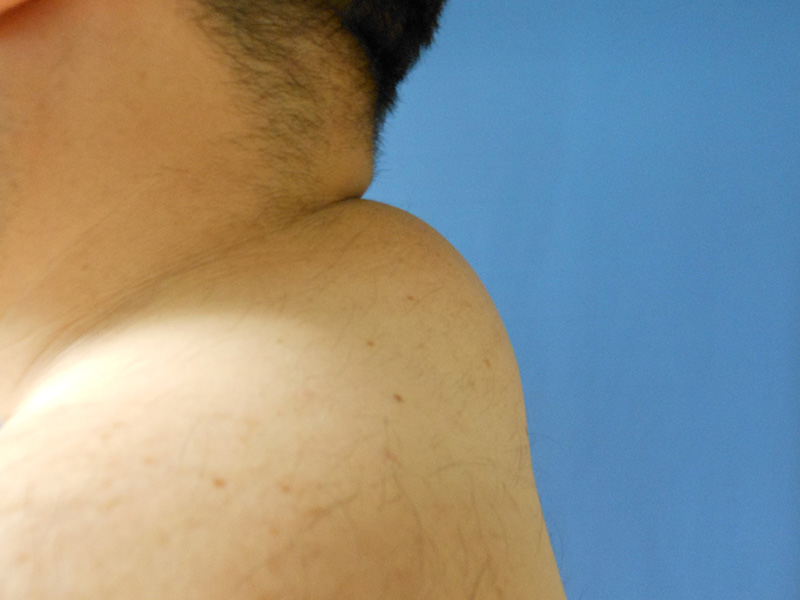 Close-up of a person's shoulder and neck against a blue background