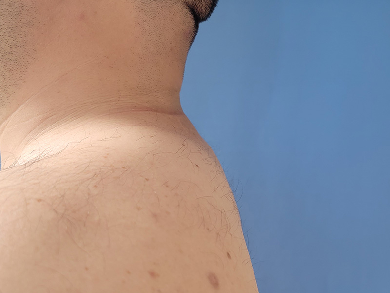 Profile view of a neck and shoulder against a blue background