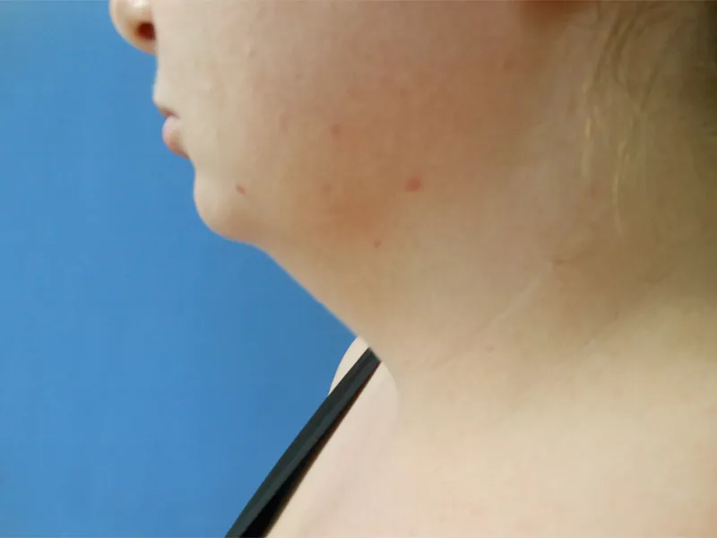 Profile view of a person's neck and jawline against a blue background