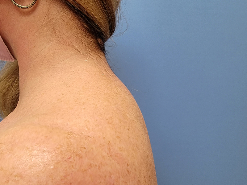 Profile view of a person's shoulder and neck against a blue background