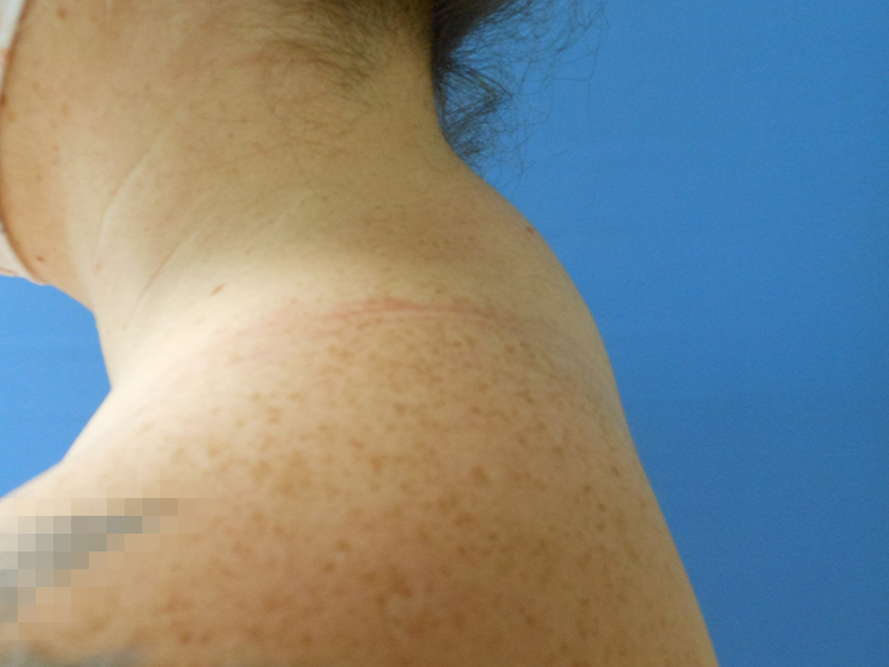 Close-up of a person's shoulder and neck with freckles against a blue background