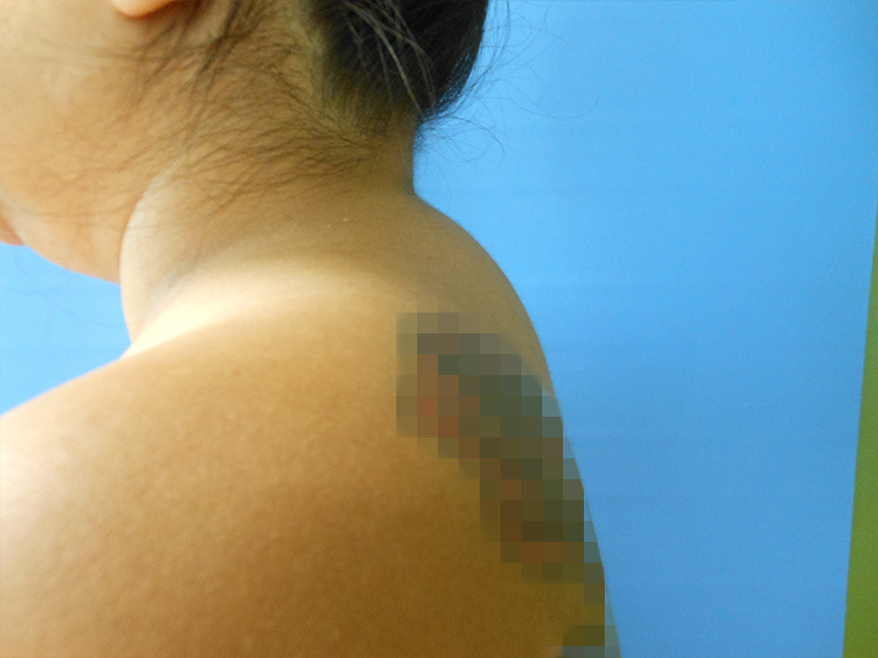 A woman's shoulder with a partially obscured tattoo against a blue background
