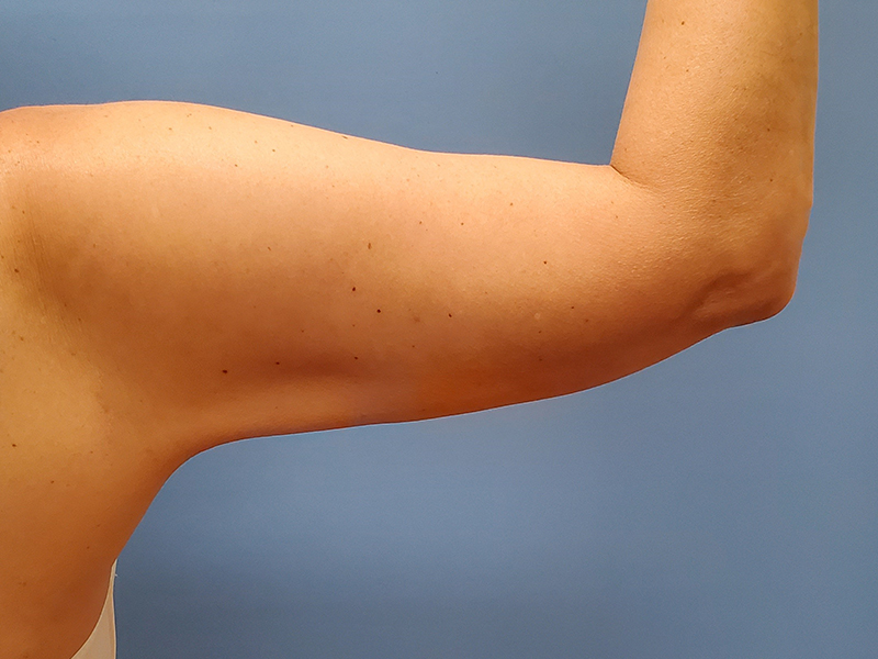 A close-up of a flexed human arm against a blue background