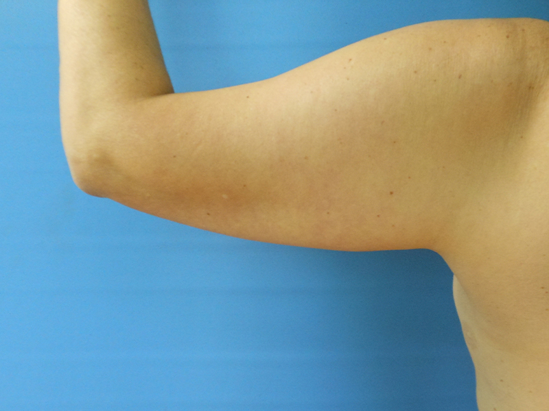 Image of a bare arm showing the bicep against a blue background