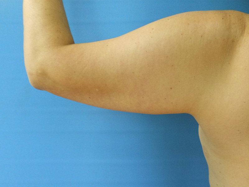 A close-up of a bare arm against a blue background