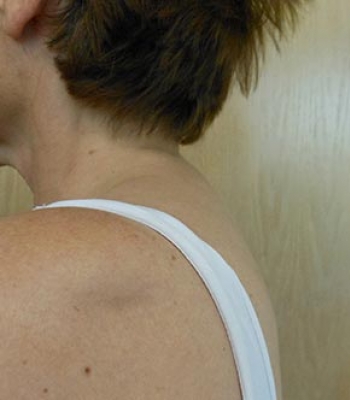 Side view of a person’s neck and shoulder with short hair and a white strap