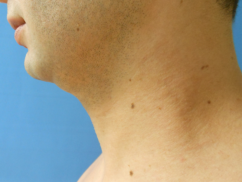 Profile of a man's neck and jawline against a blue background