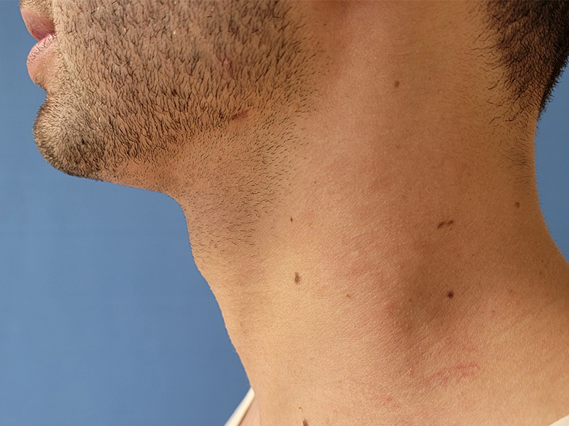 Side view of a man's neck with stubble and visible skin blemishes. Blue background