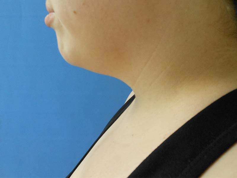 Profile of a person's neck and chin against a blue background