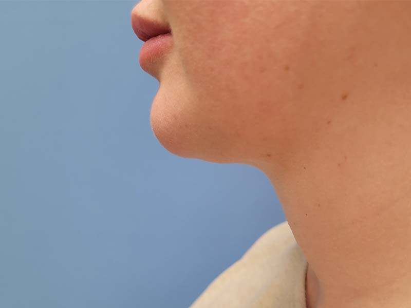 Profile view of a person's jawline and neck against a blue background