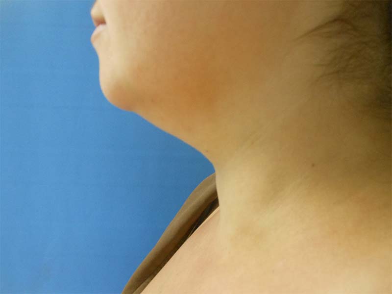 Profile view of a person's neck and shoulder against a blue background