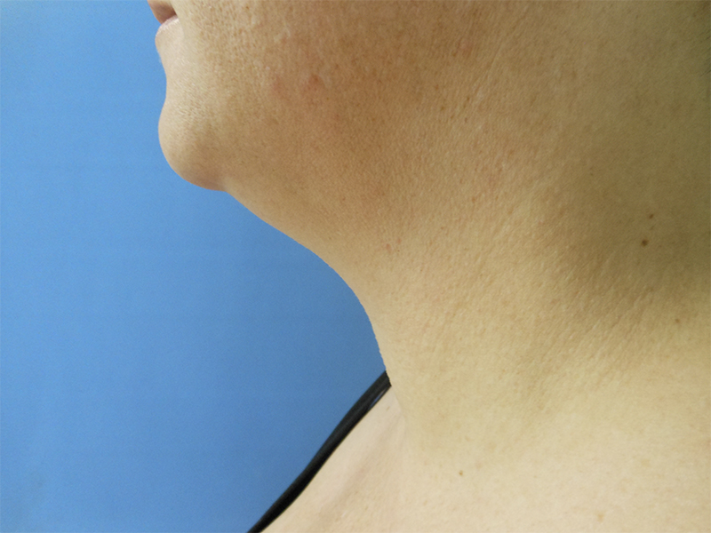 Profile view of a person's neck and chin against a blue background