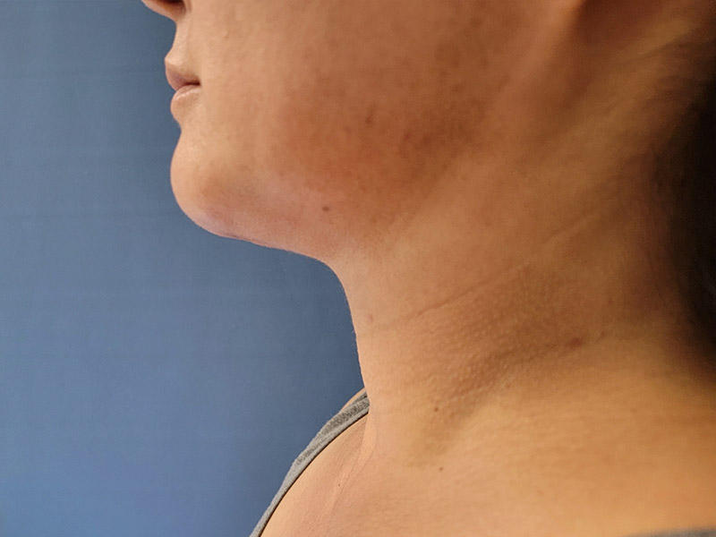 Profile view of a person's neck and jawline against a blue background