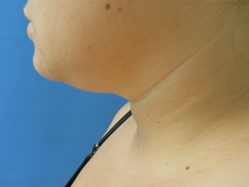 Profile view of a person's neck and chin against a blue background