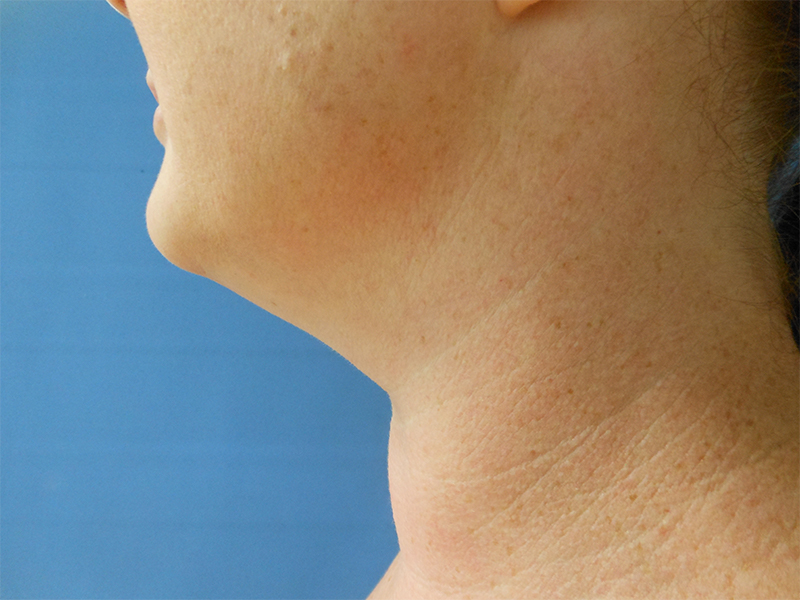 Side profile of a person's neck against a blue background