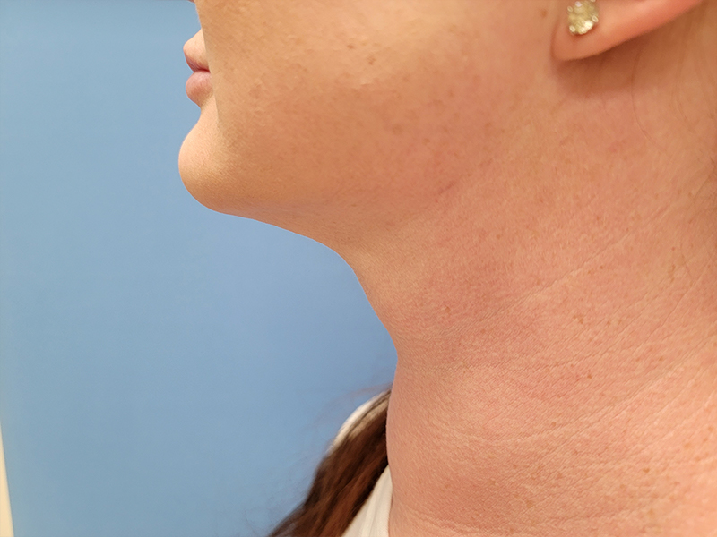 Profile view of a person’s neck and jawline against a blue background