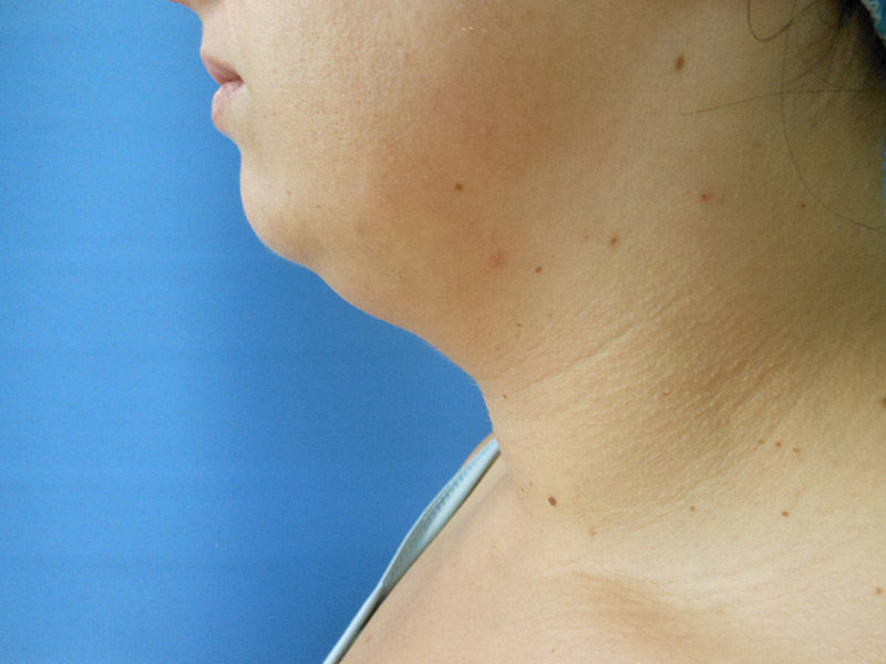 Side profile of a person’s neck and chin against a blue background