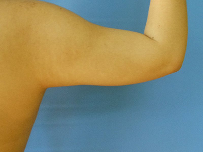 A bare arm flexing, showing the bicep against a blue background