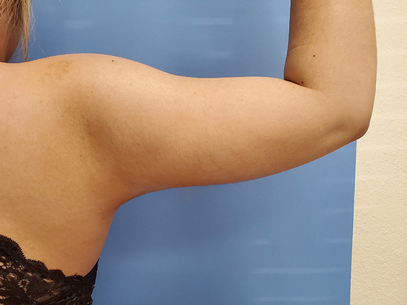 A close-up of a bare arm against a blue background, showing the upper arm and shoulder