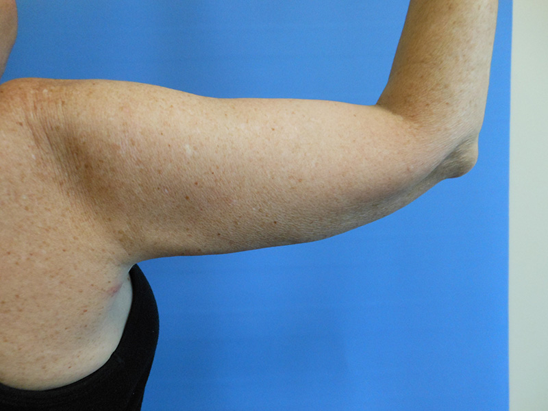 A close-up of a bare upper arm against a blue background